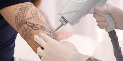 Laser tattoo removal