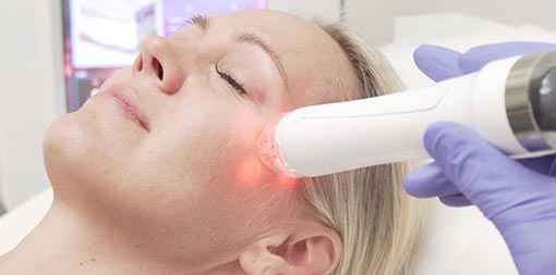 Microneedling radio frequency service