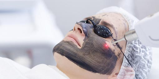 laser carbon facial